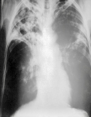 X-ray showing TB damage to lungs